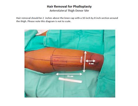 phalloplasty healed results|Phalloplasty for Gender Affirmation .